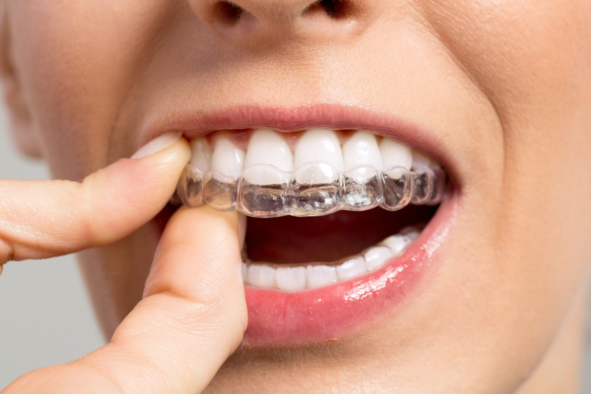 Clear aligners